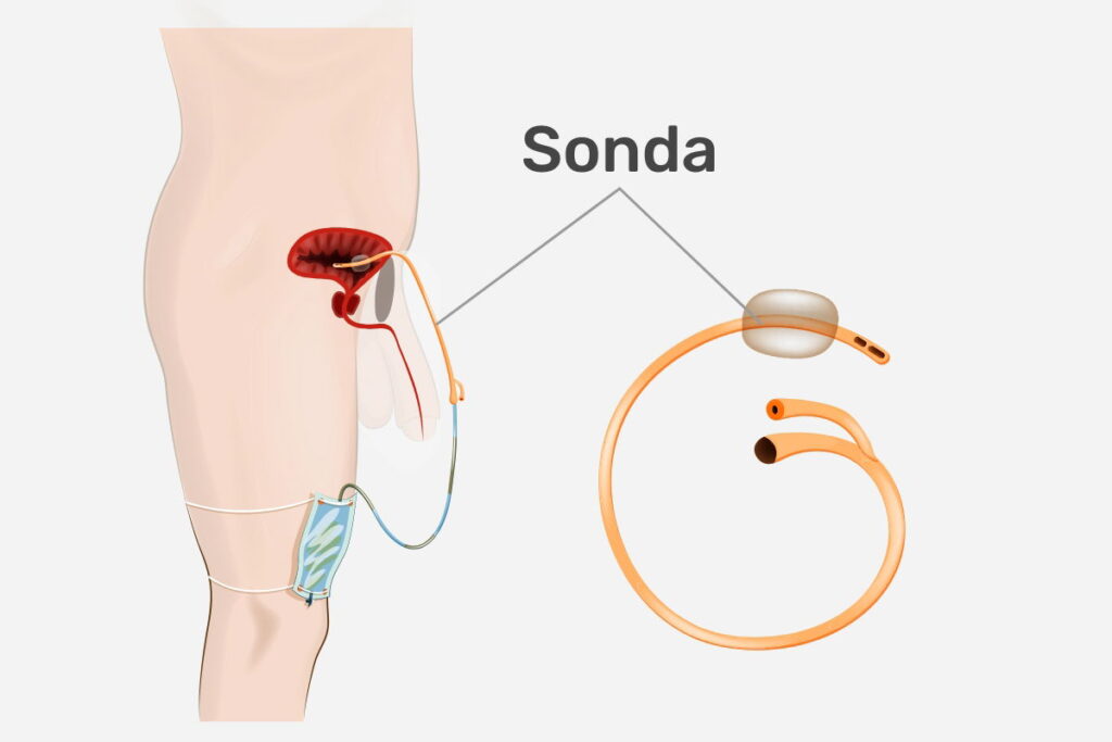 cistostomia-1024x683 Cistostomia